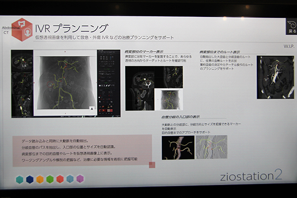 仮想透視画像作成から血管認識までを自動化するIVRプランニング（W.I.P.）