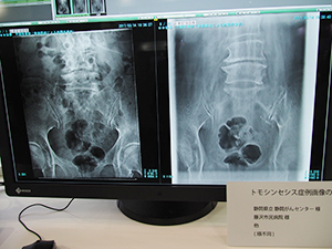 トモシンセシスの症例画像：仙骨不顕性骨折（骨粗鬆症による脆弱性骨折）