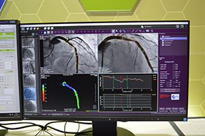 “QFR解析”が可能な「QAngio XA 3D」