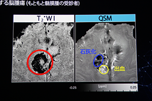 MRI定量化技術“QSM”では石灰化と出血の鑑別が可能