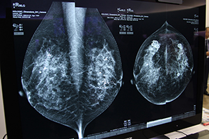 石灰化や腫瘤の検出支援を行う“ImageChecker 9.3”