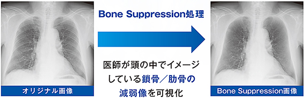 胸部Bone Suppression処理サービス