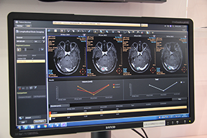 脳腫瘍の経時的変化をグラフで表示するMRIアプリケーション“LoBI”