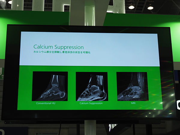 「IQon Elite Spectral CT」で可能となった“Calcium Suppression”