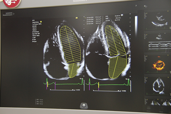 AI技術の利用で心臓内腔を自動トレースするeSie Measure