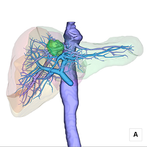 図3：肝静脈，門脈，下大静脈の抽出