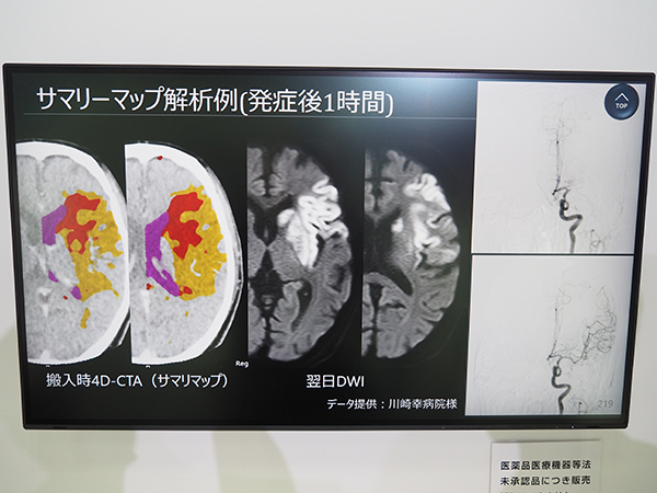 “ベイズ推定アルゴリズムを用いた4D-perfusion”による急性期脳梗塞のサマリーマップ