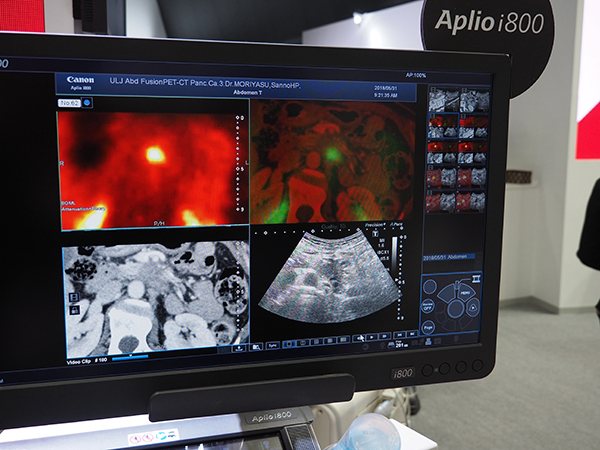 Aplio i800のSmart Fusion。PET-CTの画像をQuad Viewで表示して穿刺をサポート。