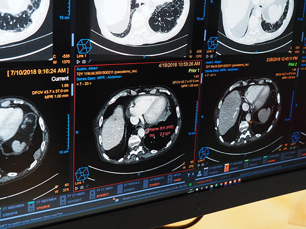 自社開発のAIによる胸部CT画像での肺結節の自動認識・抽出（W.I.P.）