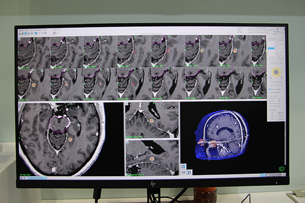 治療計画装置「GammaPlan Ver11.1」のデモンストレーション画面。腫瘍を囲むように照射エリアを設定する。