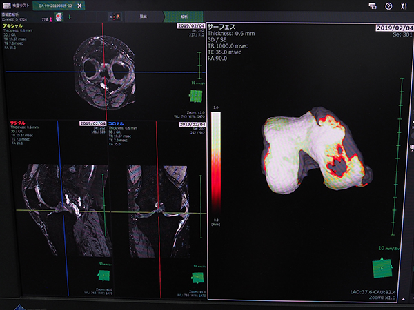 「SYNAPSE VINCENT」の最新バージョンに搭載された“膝関節解析”