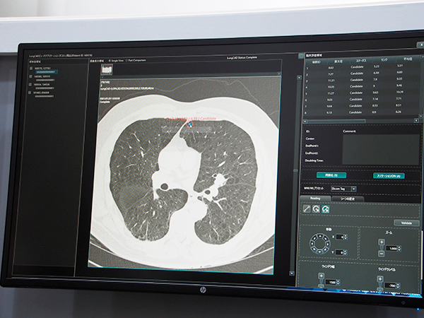 “DI×AI”の肺がんCADデモンストレーション（W.I.P.）