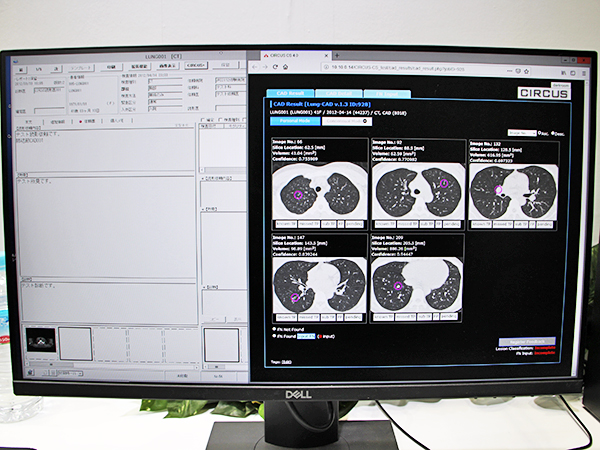 AI技術展示（W.I.P.）のCIRCUSを用いた肺結節病変抽出画面。