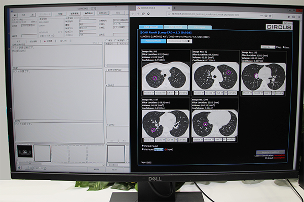 AI技術展示（W.I.P.）のCIRCUSを用いた肺結節病変抽出画面