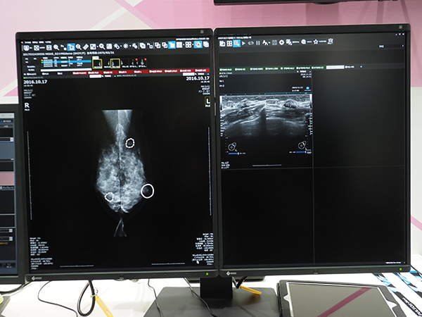「NEOVISTA I-PACS CAD typeM」で石灰化や腫瘤などを検出