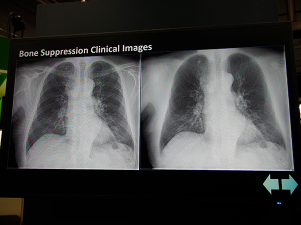 画像を転送するだけで胸部骨除去画像を得られる“Bone Suppression”