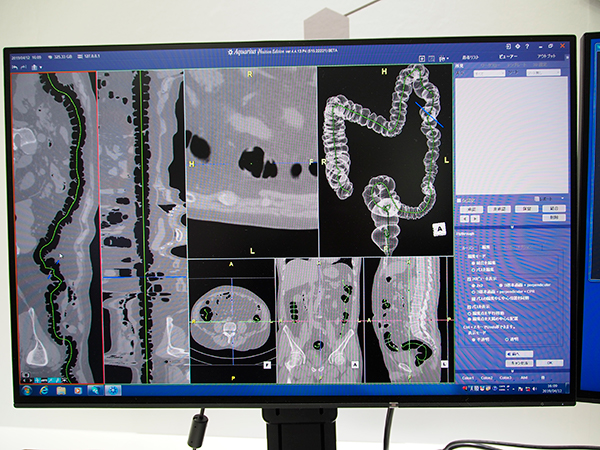 CRPでパスの修正が可能になる大腸CT解析（Aquarius iNtuition Server）