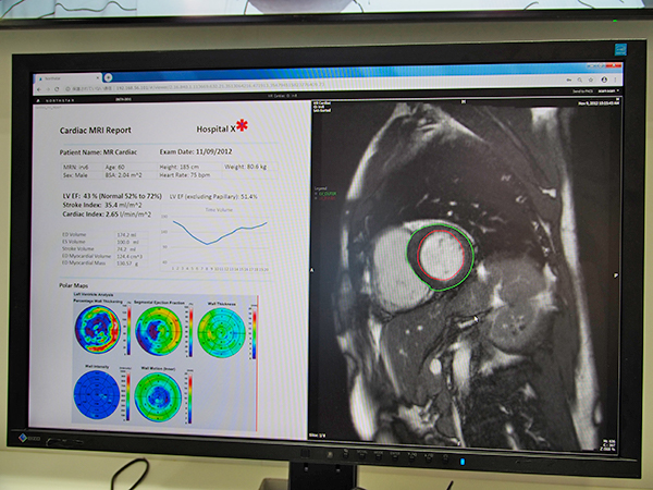 心臓MRIの心機能解析