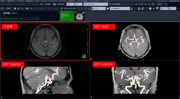 ShadeQuest/ViewR-DGの脳動脈瘤表示