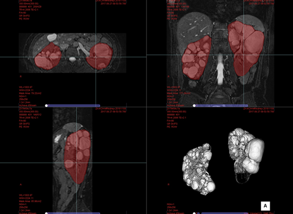 図3：MR検査画像の腎臓抽出