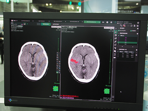 SYNAPSE VINCENTの脳解析ソフトウエアの高信号領域の強調表示