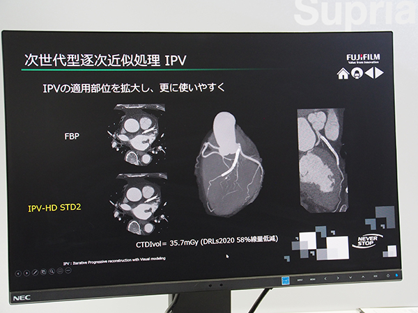 SCENARIA Viewでは逐次近似処理技術“IPV”が心臓にも適用可能に