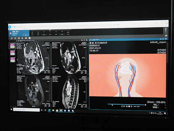 統合検査ビューア「ULite」では，画像情報と患者説明用のアニメーションを同時に表示することが可能
