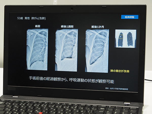 X線動画解析ワークステーション「KINOSIS」で手術前後の呼吸運動の状態が観察できる