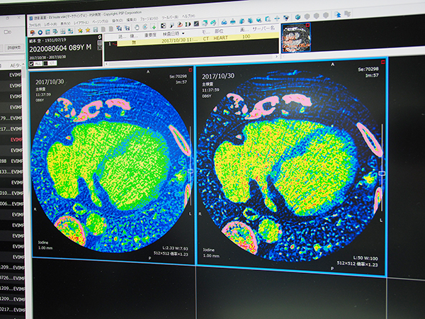 dual energy CTの定量化解析・ECV画像