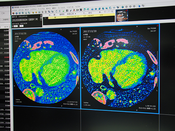 心筋の線維化評価を支援する定量化解析・ECV画像（右）