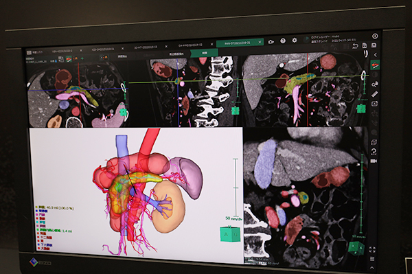 膵臓手術のシミュレーション画像を提供