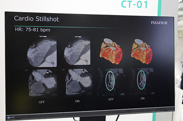 Cardio StillShotは，Rawデータから心臓全体の動きを四次元的に推定して再構成することで動きのアーチファクトを低減