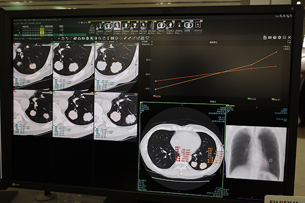 胸部CT画像での肺結節の自動検出，自動計測，経時評価
