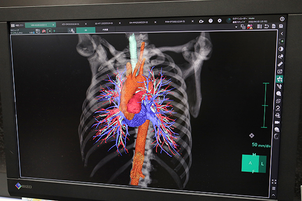 肺の動静脈（PA/PV）分離，大動脈抽出で非造影による胸部血管を描出