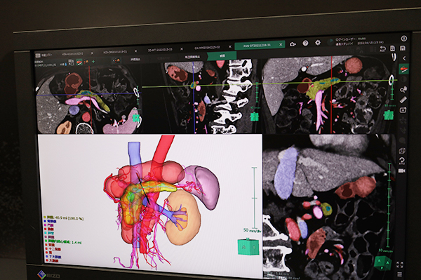 膵臓解析では膵臓と周辺臓器，血管系を含めて自動抽出して手術支援画像を作成可能