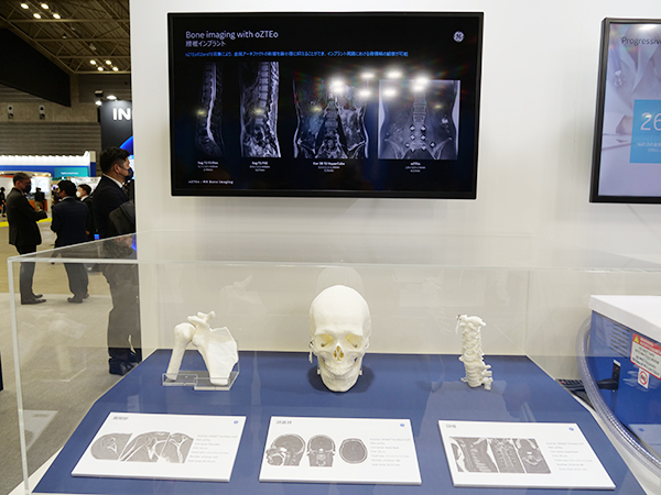 “oZTEo”は独自のゼロTE技術により骨を画像化