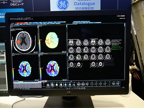 急性期脳梗塞の迅速な診断・治療を支援する脳画像解析プログラム“PMAneo”