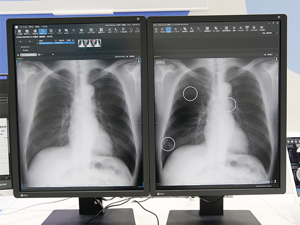 病変候補を白色の丸でマークする胸部X線画像診断支援ソフトウエア“CXR Finding-i”