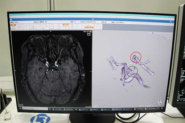 現在開発中の頭部MRAによる脳動脈瘤検出のためのCAD