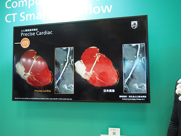 “Precise Suite”の一つである心臓画像再構成機能“Precise Cardiac”