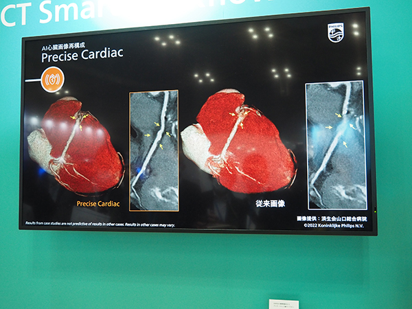 “Precise Suite”の一つである心臓画像再構成機能“Precise Cardiac”