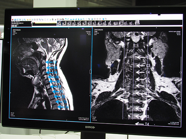 「EV Insite R」に追加された脊椎ラベリングをアノテーションとして保存する機能