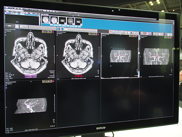 頭部MRAから脳動脈瘤の候補を検出・表示するエルピクセルの「EIRL Brain Aneurysm」