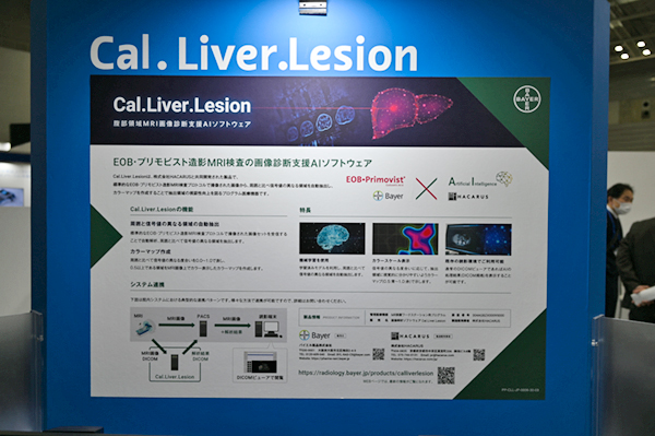 肝臓領域における造影MRIの読影を支援するAIソフトウェア「Cal.Liver.Lesion」