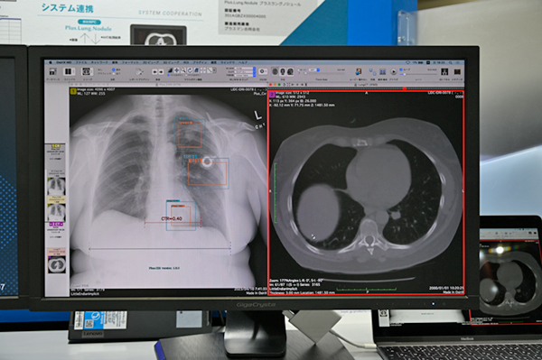 「Plus.Lung.Nodule」には「Plus.CXR」（左）を追加可能