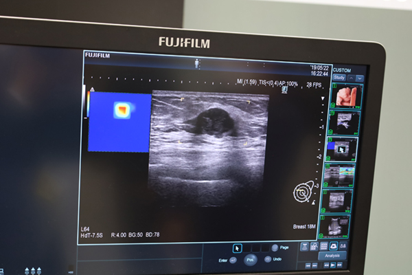 AI技術を用いた画像認識技術で乳腺の検出支援を行う「eScreening」機能