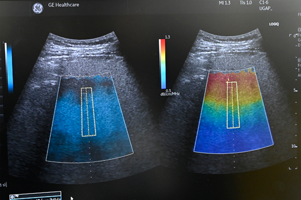 「LOGIQシリーズ」に採用された減衰イメージング「Ultrasound-Guided Attenuation Parameter（UGAP）」