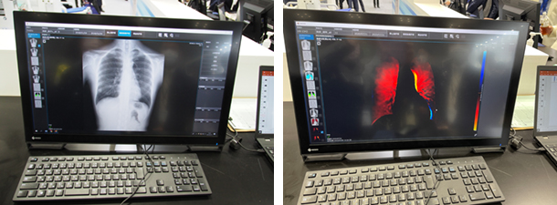 KINOSISの画像 通常の動画像（左）と肺血流画像（右）