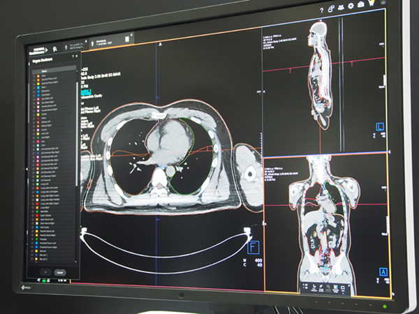 85以上の臓器に対応する治療計画支援システム「syngo.via RT Image Suite」