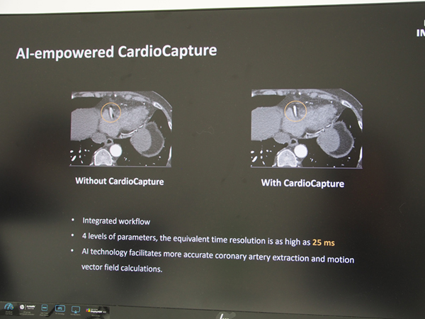 AIで冠動脈の動きを解析してブレのない画像を取得する「CardioCapture」